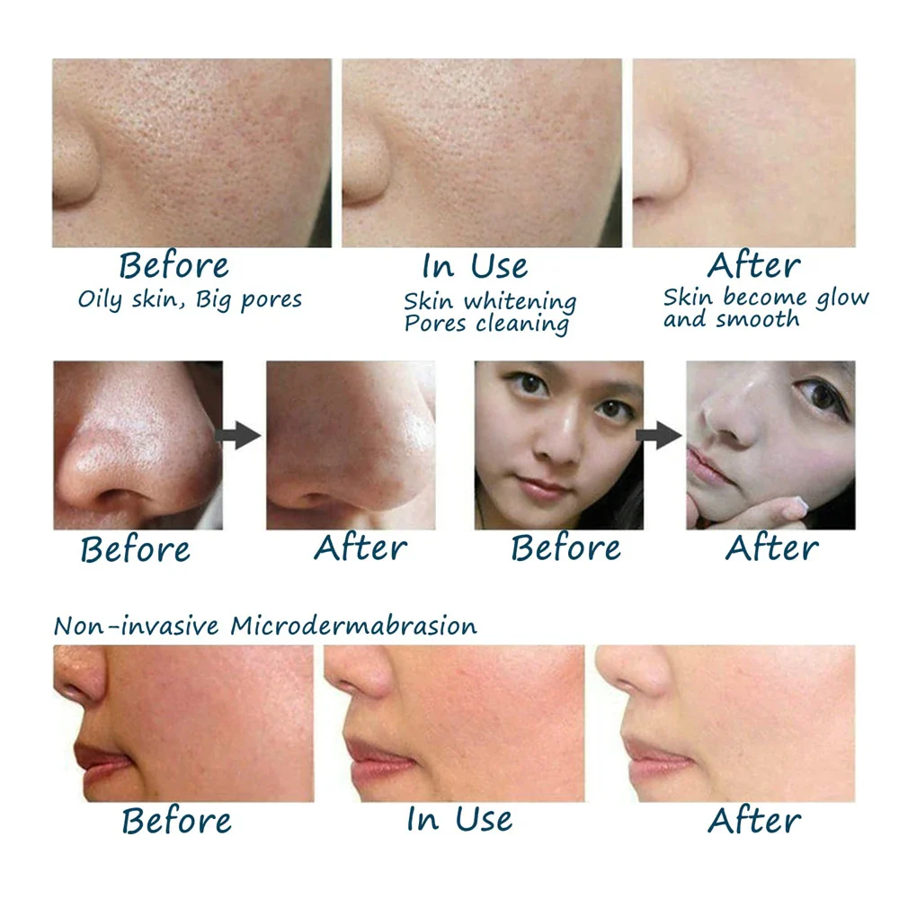 microderm resutl